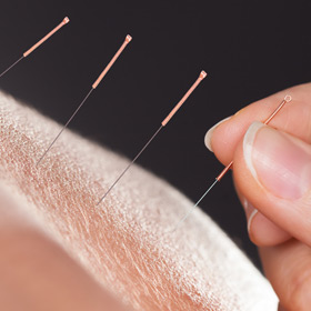 T-acupuncture